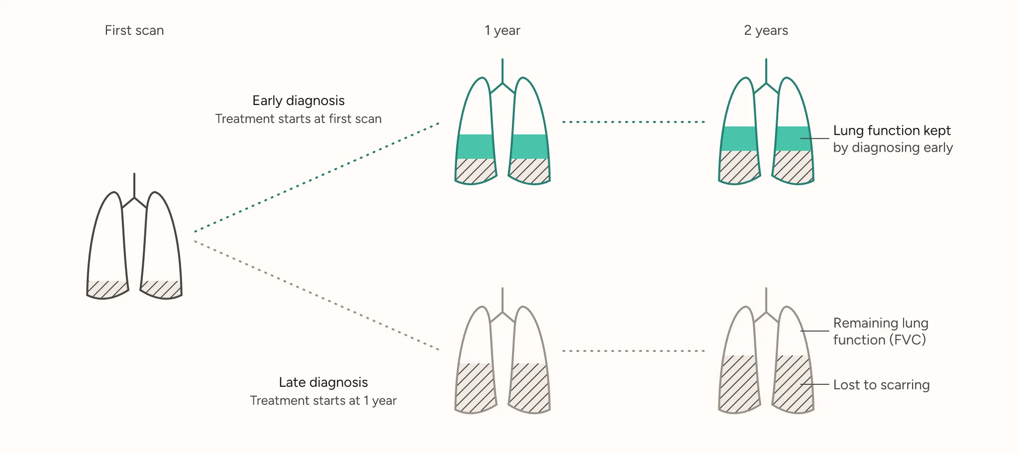 Two paths from the same first scan: with early diagnosis, teal lungs keep a teal band of function at one and two years; with late diagnosis, gray lungs have more of each lung hatched as lost to scarring